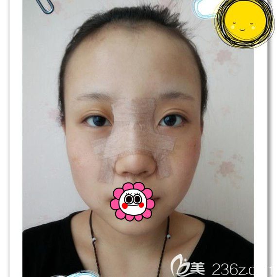 黑龙江瑞丽鼻整形术后5天