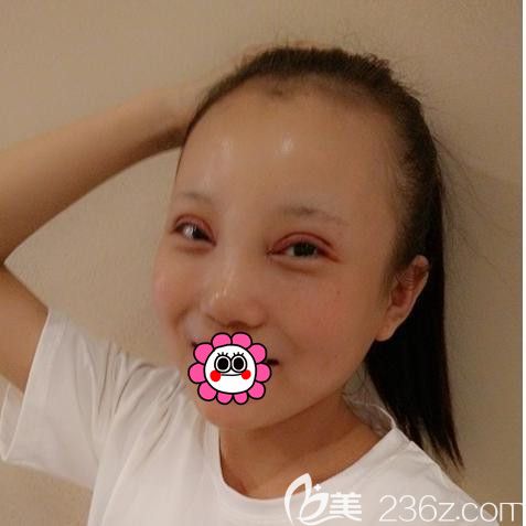 黑龙江瑞丽切开双眼皮术后4天