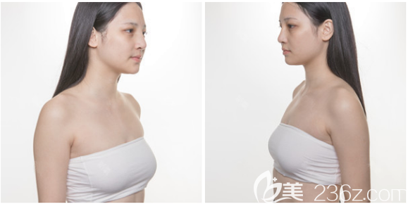 在广州曙光做隆胸的术前照片 在广州曙光做隆胸的术前照片