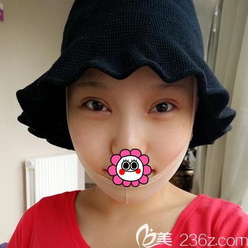 黑龙江瑞丽隆下巴术后恢复