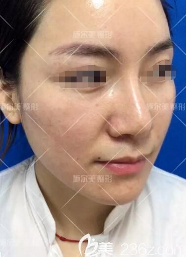 面诊常州施尔美术前油性皮肤总长痘 面诊常州施尔美术前油性皮肤总长痘