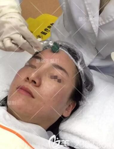 常州施尔美医生做微针美塑过程中 常州施尔美医生做微针美塑过程中