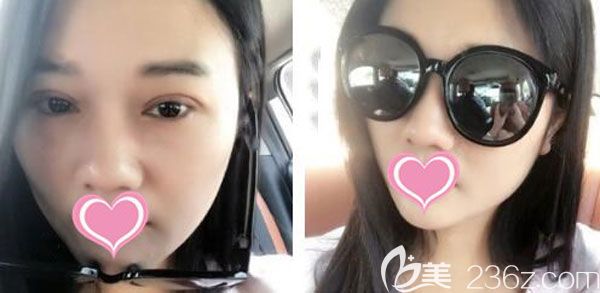 双眼皮修复手术7天形状很满意