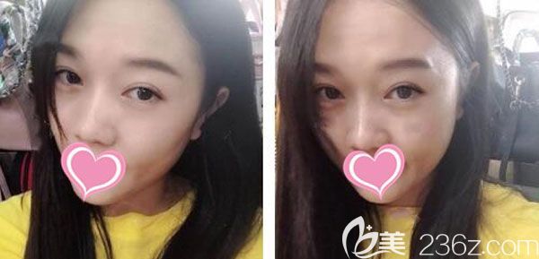 双眼皮修复手术20天疤痕恢复得<span style=