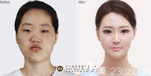 韩国灰姑娘(新帝瑞娜)面部轮廓整形案例