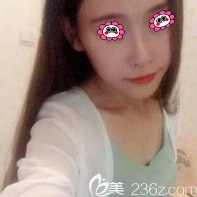 自体脂肪丰胸前的照片 自体脂肪丰胸前的照片