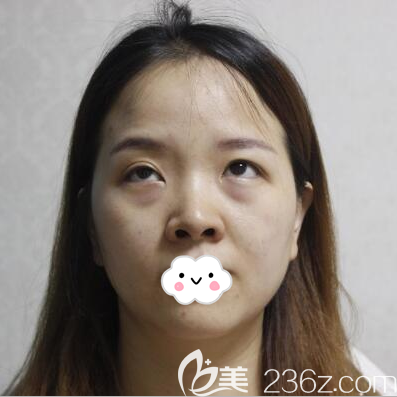 去眼袋手术前照片 去眼袋手术前照片