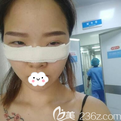 程红涛内切去眼袋术后即刻 程红涛内切去眼袋术后即刻