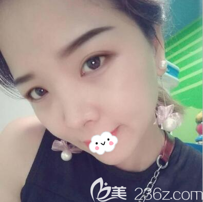 程红涛院长去眼袋术后6天 程红涛院长去眼袋术后6天