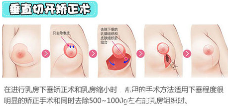 垂直切开矫正乳房下垂手术示意图