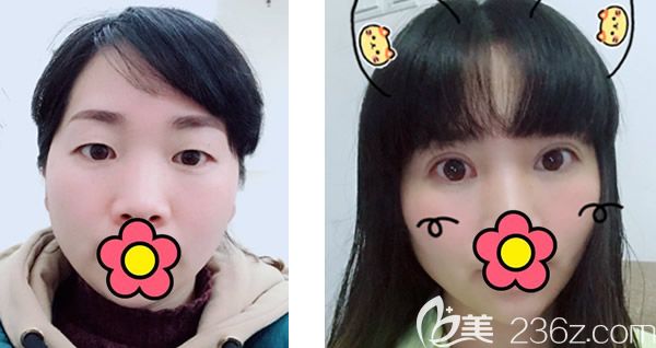 呼和浩特五洲王焕割双眼皮怎么样 呼和浩特五洲王焕割双眼皮怎么样