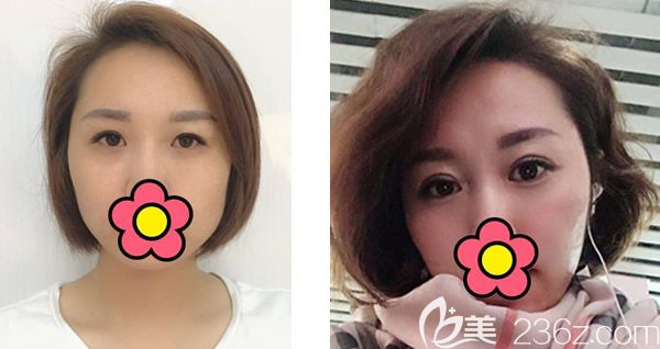 呼市五洲王焕内双割双眼皮效果案例 呼市五洲王焕内双割双眼皮效果案例