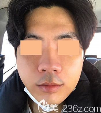在韩国faceline做面部轮廓手术后2周