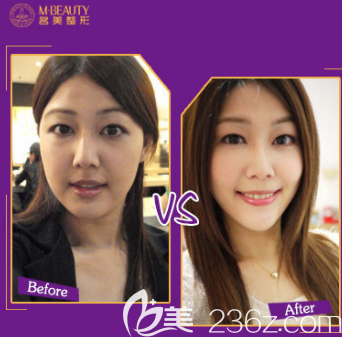 <!--<i data=20240703-sp></li>
<li><i data=20240703-sp></i>-->瘦脸除皱瘦脸案例