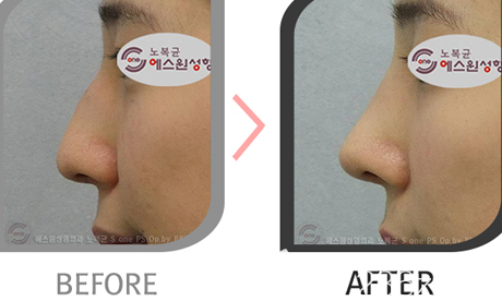 韩国S-ONE整形美容中心驼峰鼻矫正案例