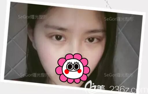 术后三天韩式双眼皮肿胀已经消退