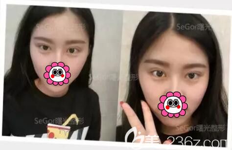 一周拆线后韩式双眼皮恢复中