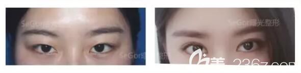 到常州曙光做韩式双眼皮术前术后对比