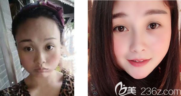 五洲整形<!--<i data=20240703-sp></i>-->面部脂肪填充效果好不好