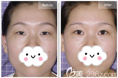 唐山苏亚美联臣做双眼皮案例