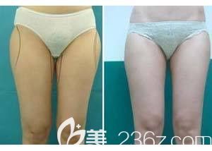 苏亚美联臣整形医院做大腿吸脂案例
