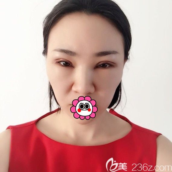 黑龙江瑞丽眼综合手术5天效果