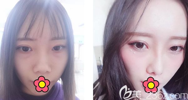 呼市五洲王焕自体肋软骨综合隆鼻案例