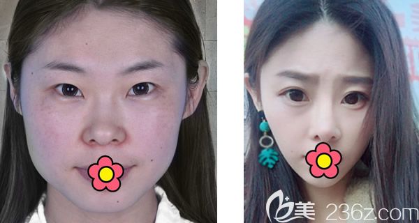 呼市五洲王焕假体隆鼻+面部脂肪填充+激光祛斑案例