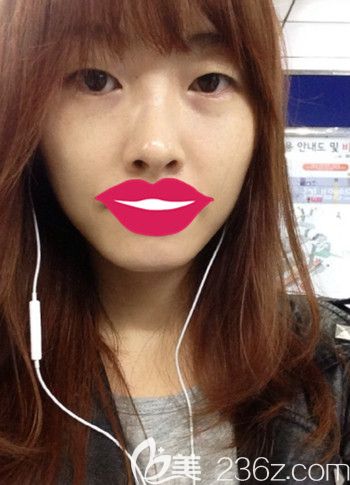 我在韩国S-ONE整形外科做面部脂肪填充+眼鼻整形后2个月就拥有了好看的小脸