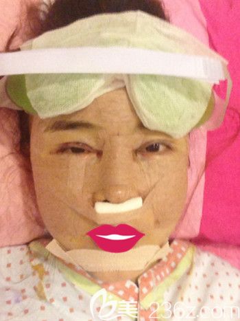 我在韩国S-ONE整形外科做面部脂肪填充+眼鼻整形+丰下巴当天 我在韩国S-ONE整形外科做面部脂肪填充+眼鼻整形+丰下巴当天