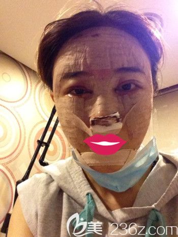 我在韩国S-ONE整形外科做面部脂肪填充+眼鼻整形+丰下巴第二天 我在韩国S-ONE整形外科做面部脂肪填充+眼鼻整形+丰下巴第二天