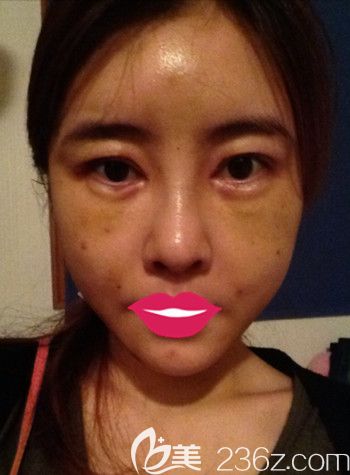 我在韩国S-ONE整形外科做面部脂肪填充+眼鼻整形+丰下巴后1周 我在韩国S-ONE整形外科做面部脂肪填充+眼鼻整形+丰下巴后1周