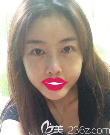 我在韩国S-ONE整形外科做面部脂肪填充+眼鼻整形+丰下巴后2周 我在韩国S-ONE整形外科做面部脂肪填充+眼鼻整形+丰下巴后2周