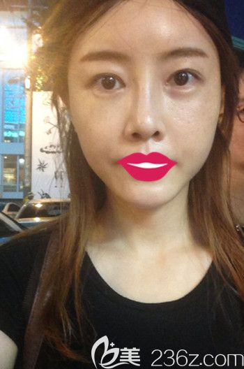 我在韩国S-ONE整形外科做面部脂肪填充+眼鼻整形+丰下巴后1个月 我在韩国S-ONE整形外科做面部脂肪填充+眼鼻整形+丰下巴后1个月