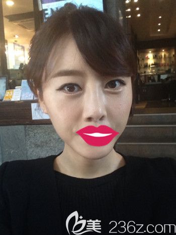 我在韩国S-ONE整形外科做面部脂肪填充+眼鼻整形+丰下巴后2个月 我在韩国S-ONE整形外科做面部脂肪填充+眼鼻整形+丰下巴后2个月