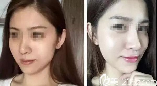 DNA童颜针换肤逆龄前后效果图 DNA童颜针换肤逆龄前后效果图