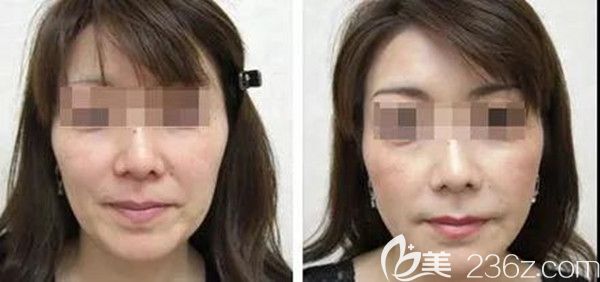 DNA童颜针注射前后对比图 DNA童颜针注射前后对比图