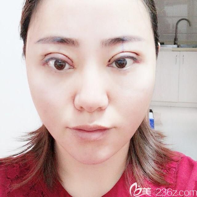 让胡准做埋线提升+眼综合+玻尿酸填充泪沟第3天