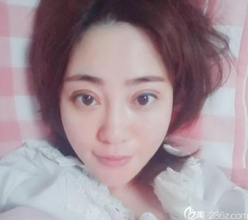 白领安琪儿全脸线雕+玻尿酸填充泪沟+眼综合7天拆线照片