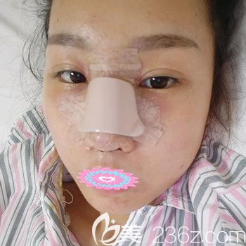 武汉同济医院曾宁医生硅胶假体隆鼻修复术后3天照片展示