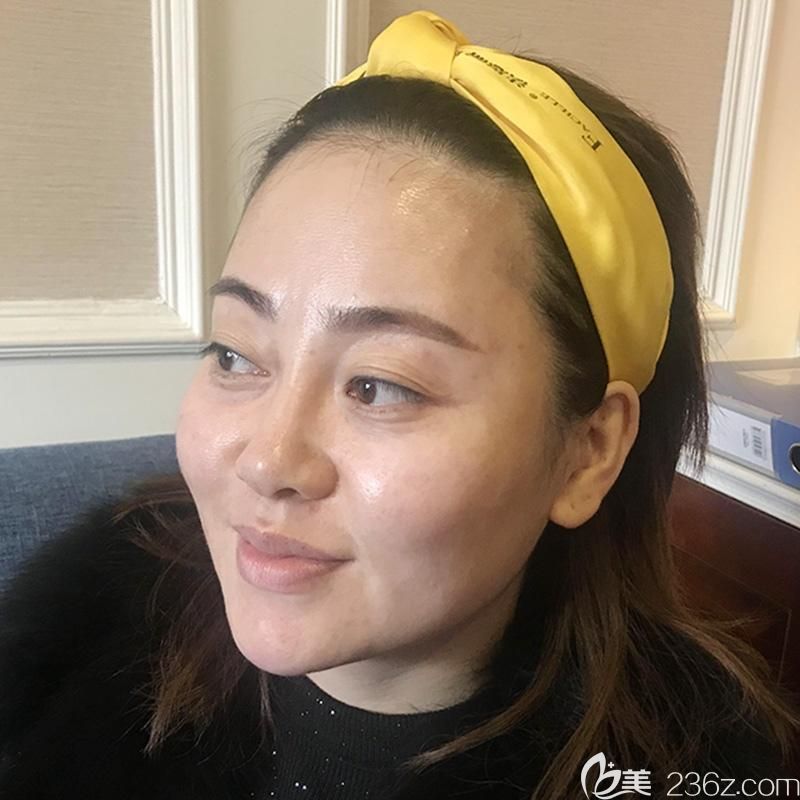 眼综合+全脸线雕+玻尿酸填充泪沟前侧面