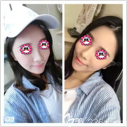 做假体垫下巴术后一周拆线 做假体垫下巴术后一周拆线