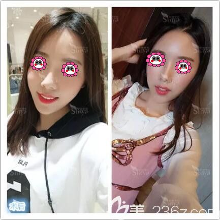 在长沙做假体垫下巴一个月效果 在长沙做假体垫下巴一个月效果