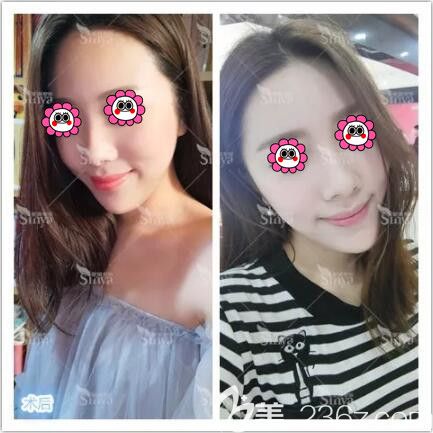 在长沙星雅做假体丰下巴一个半月恢复效果 在长沙星雅做假体丰下巴一个半月恢复效果