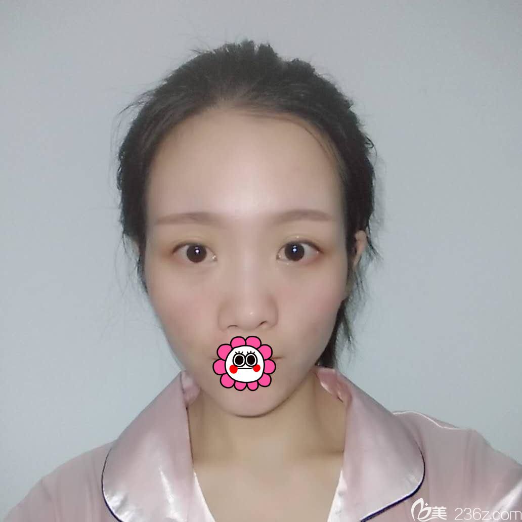 双眼皮修复术前照 双眼皮修复术前照