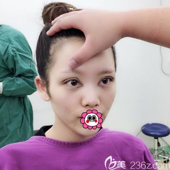 黑龙江瑞丽双眼皮修复术后即刻 黑龙江瑞丽双眼皮修复术后即刻