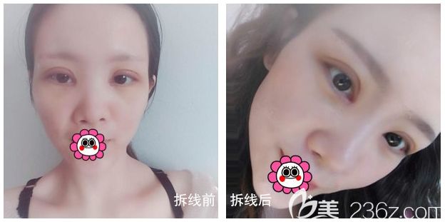 双眼皮修复拆线前后 双眼皮修复拆线前后