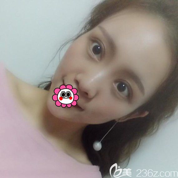 黑龙江瑞丽双眼皮修复效果怎么样? 黑龙江瑞丽双眼皮修复效果怎么样?