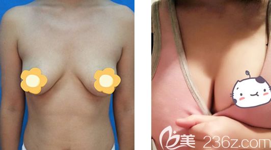 呼市五洲王焕腰腹吸脂+自体脂肪隆胸前后效果对比案例