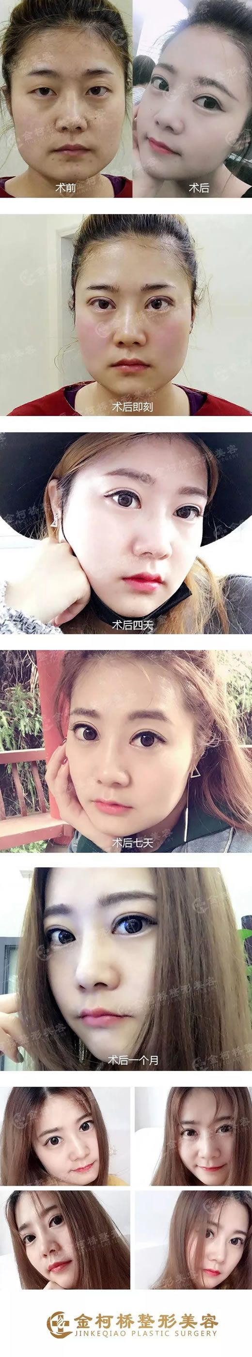 <!--<i data=20240703-sp></li>
<li><i data=20240703-sp></i>-->林建华双眼皮案例 <!--<i data=20240703-sp></i>--><!--<i data=20240703-sp></i>-->林建华双眼皮案例